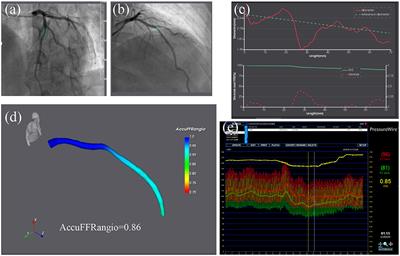 Diagnostic Performance of Angiography-Based Fractional Flow Reserve for Functional Evaluation of Coronary Artery Stenosis